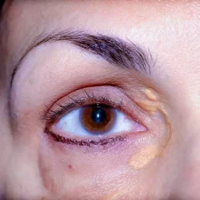 xantelasma