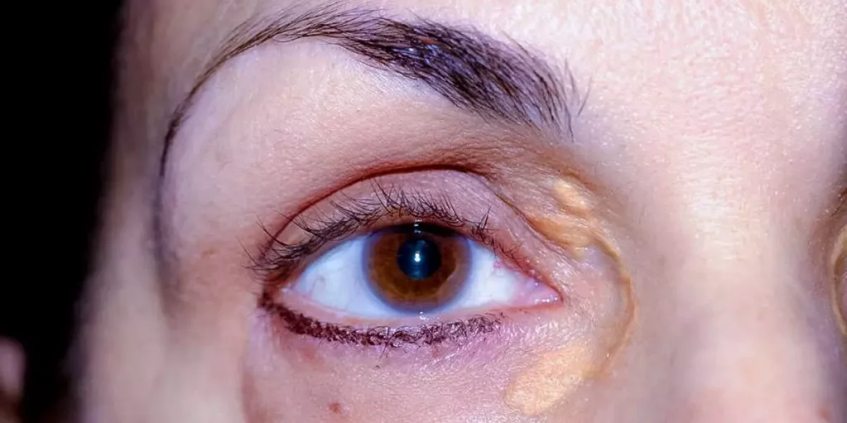 xantelasma